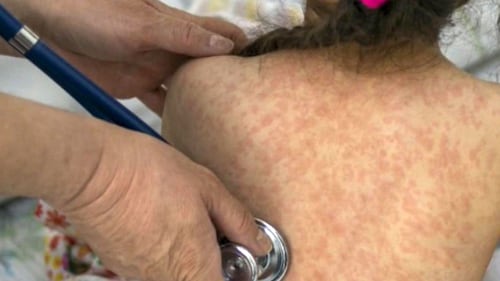 ‘No doubt an epidemic’: Health professionals warn of severity of measles